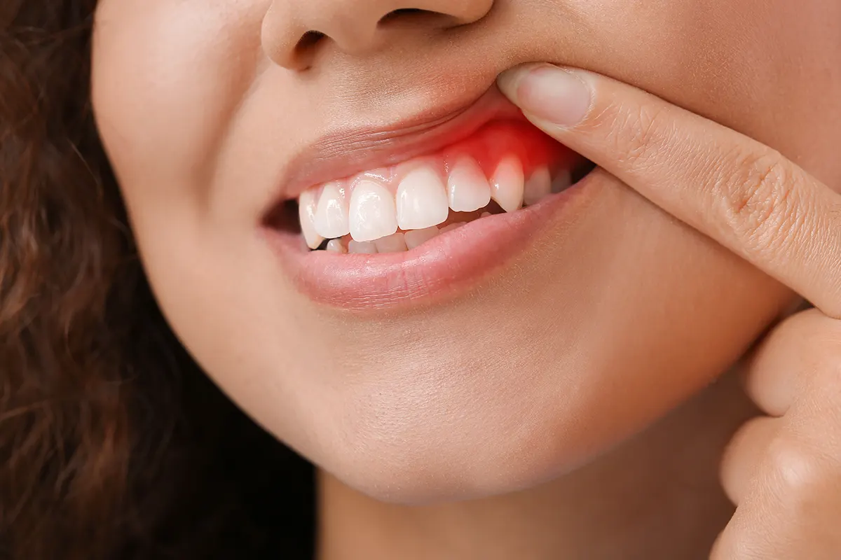 Jeune femme montrant une dent cassée et des gencives légèrement rouges près de la fissure dentaire, sourire partiel.