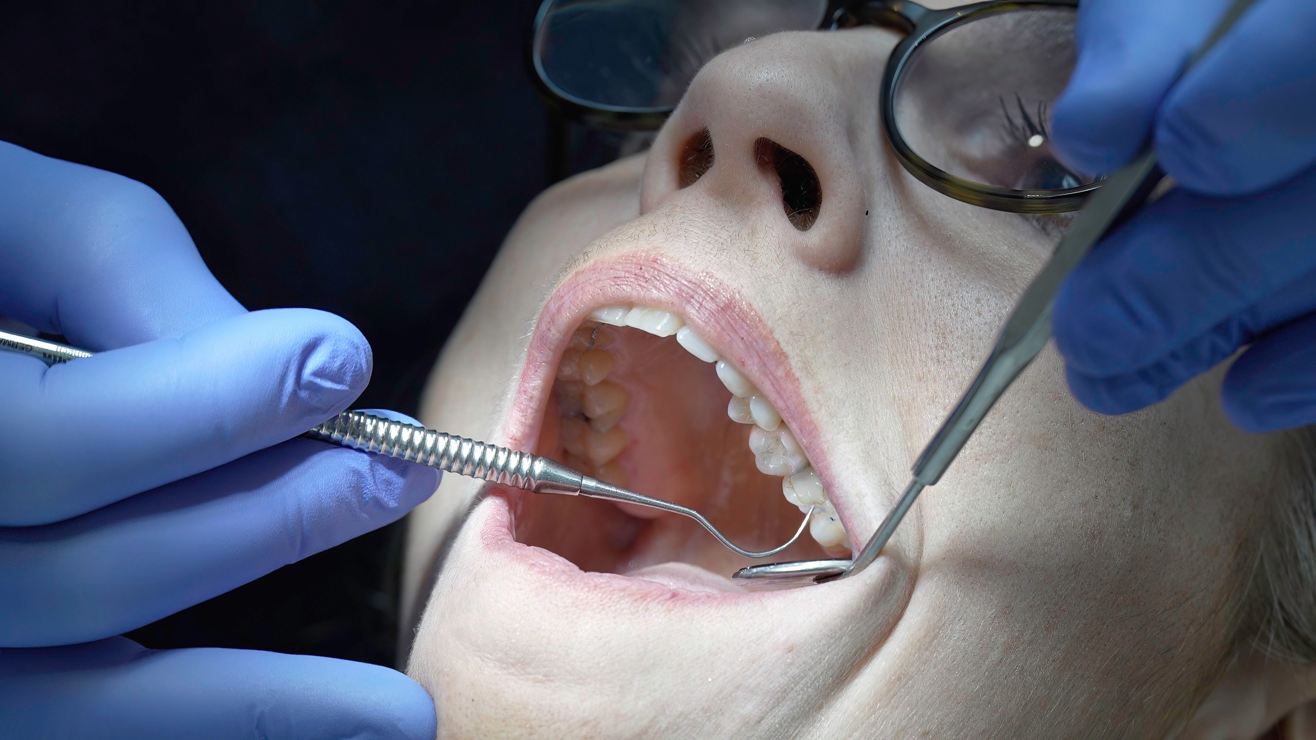Patient en examen bucco-dentaires lors d’un contrôle, avec outils dentaires et lunettes de protection.